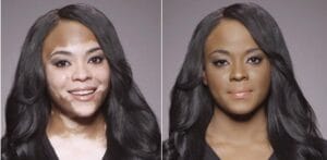coprire-la-vitiligine-con-il-make-up