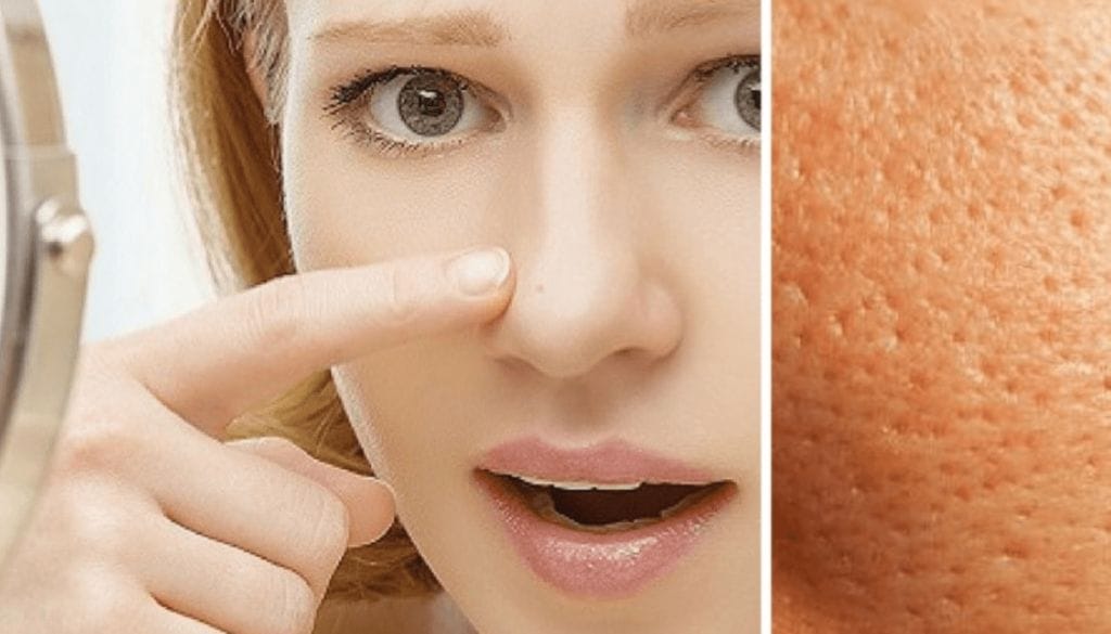 minimizzare-i-pori-dilatati