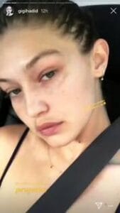 gigi-hadid-mostra-le-macchie-solari-su-instagram