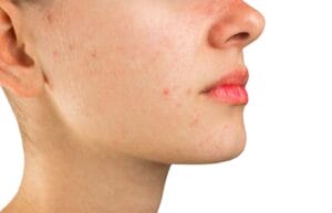 Quale-fondotinta-usare-in-caso-di-acne