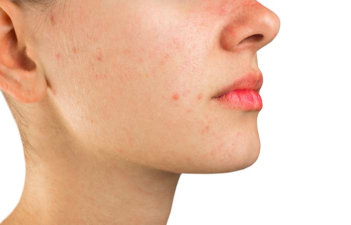 Quale-fondotinta-usare-in-caso-di-acne