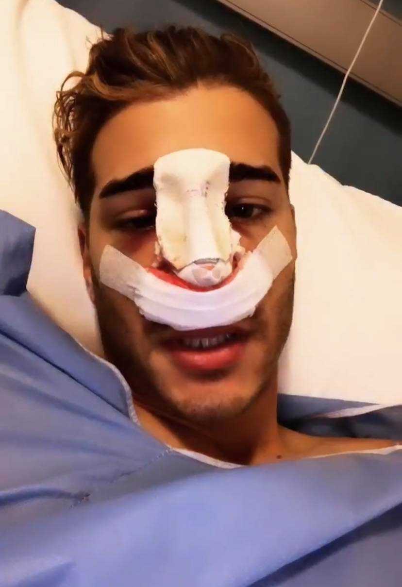 Nicolo-Ferrari-si-e-rifatto-il-naso