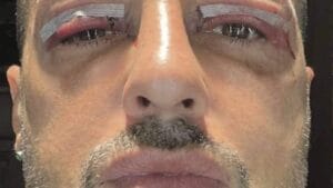 Fabrizio-Corona-Blefaroplastica